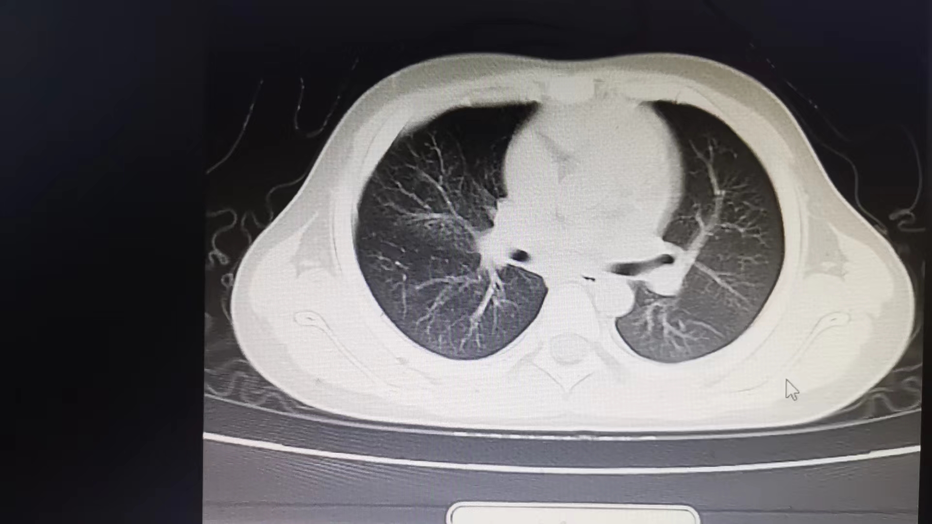 大叶性肺炎治疗6天后.jpg 大叶性肺炎治疗6天后.jpg