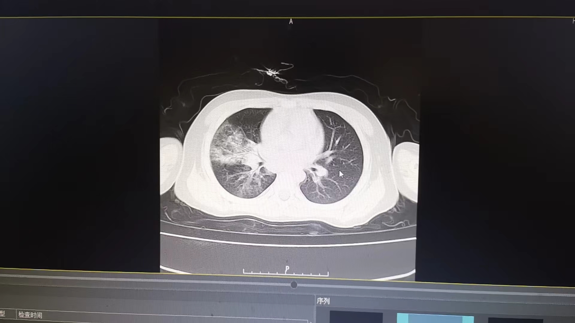 大叶性肺炎.jpg 大叶性肺炎.jpg