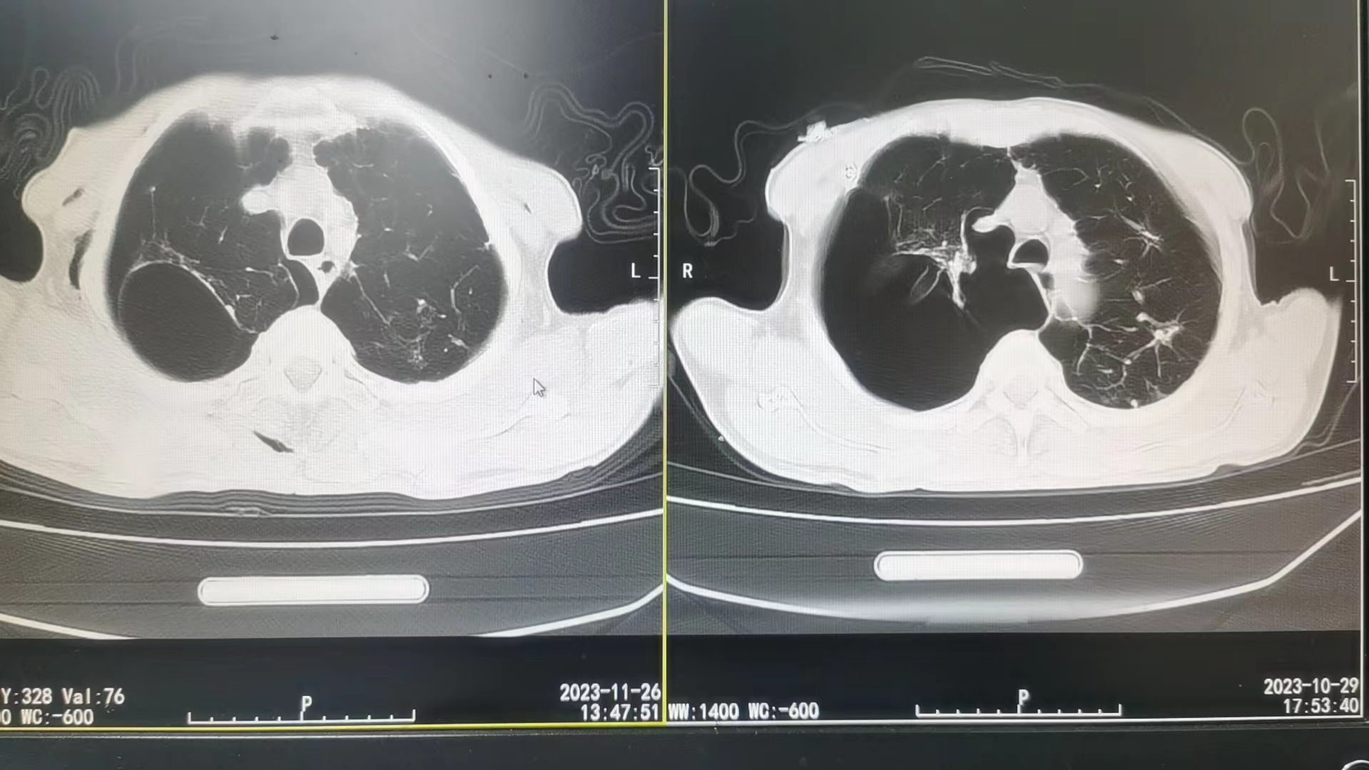 肺大泡CT图.jpg 肺大泡CT图.jpg